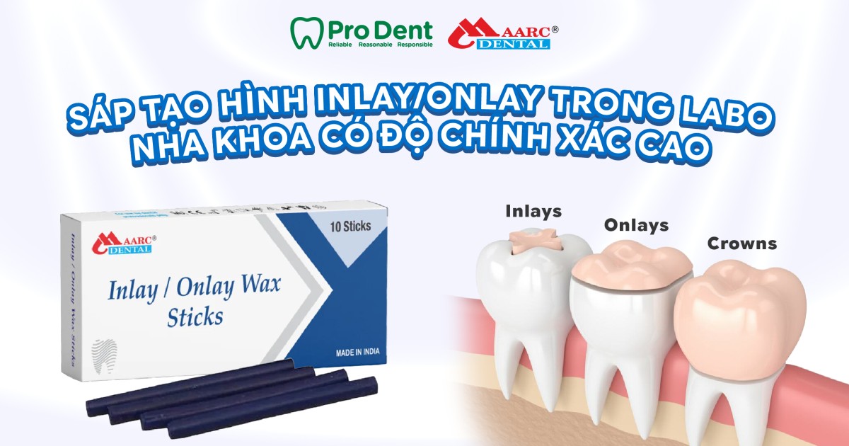 Sáp tạo hình inlay/onlay trong labo nha khoa có độ chính xác cao