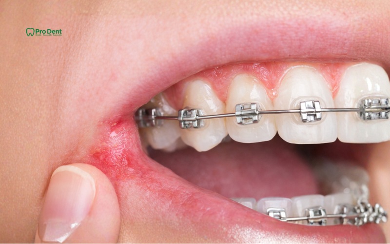 Các nguy cơ và biến chứng có thể gặp trong chỉnh nha