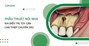 Phẫu thuật nội nha: Khi nào điều trị tủy cần can thiệp chuyên sâu?