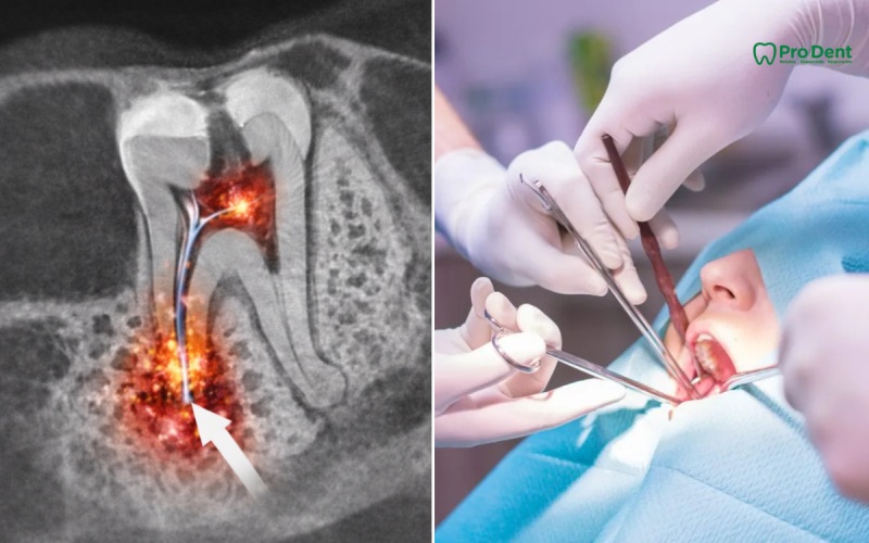 Vai trò của chẩn đoán hình ảnh và vật liệu nội nha trong phẫu thuật