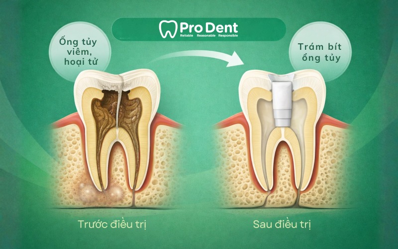 Cách điều trị nội nha bảo tồn răng thật một cách tối ưu