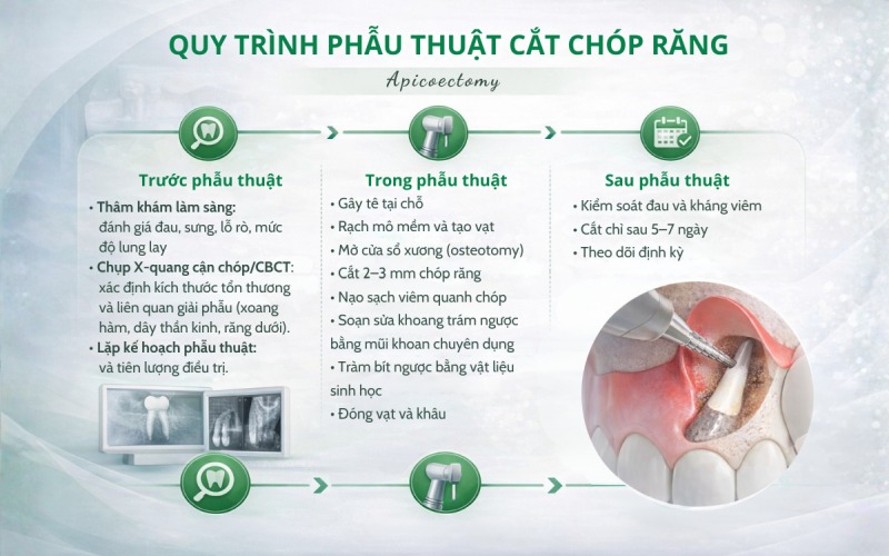  Quy trình phẫu thuật cắt chóp răng