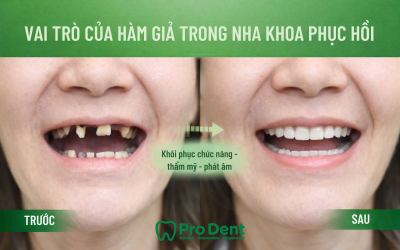 VAI TRÒ CỦA HÀM GIẢ TRONG NHA KHOA PHỤC HỒI
